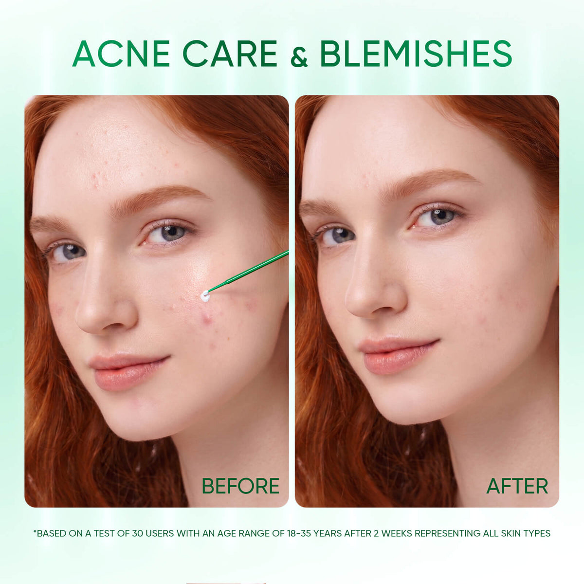 Acne Drying Lotion Overnight Spot Treatment